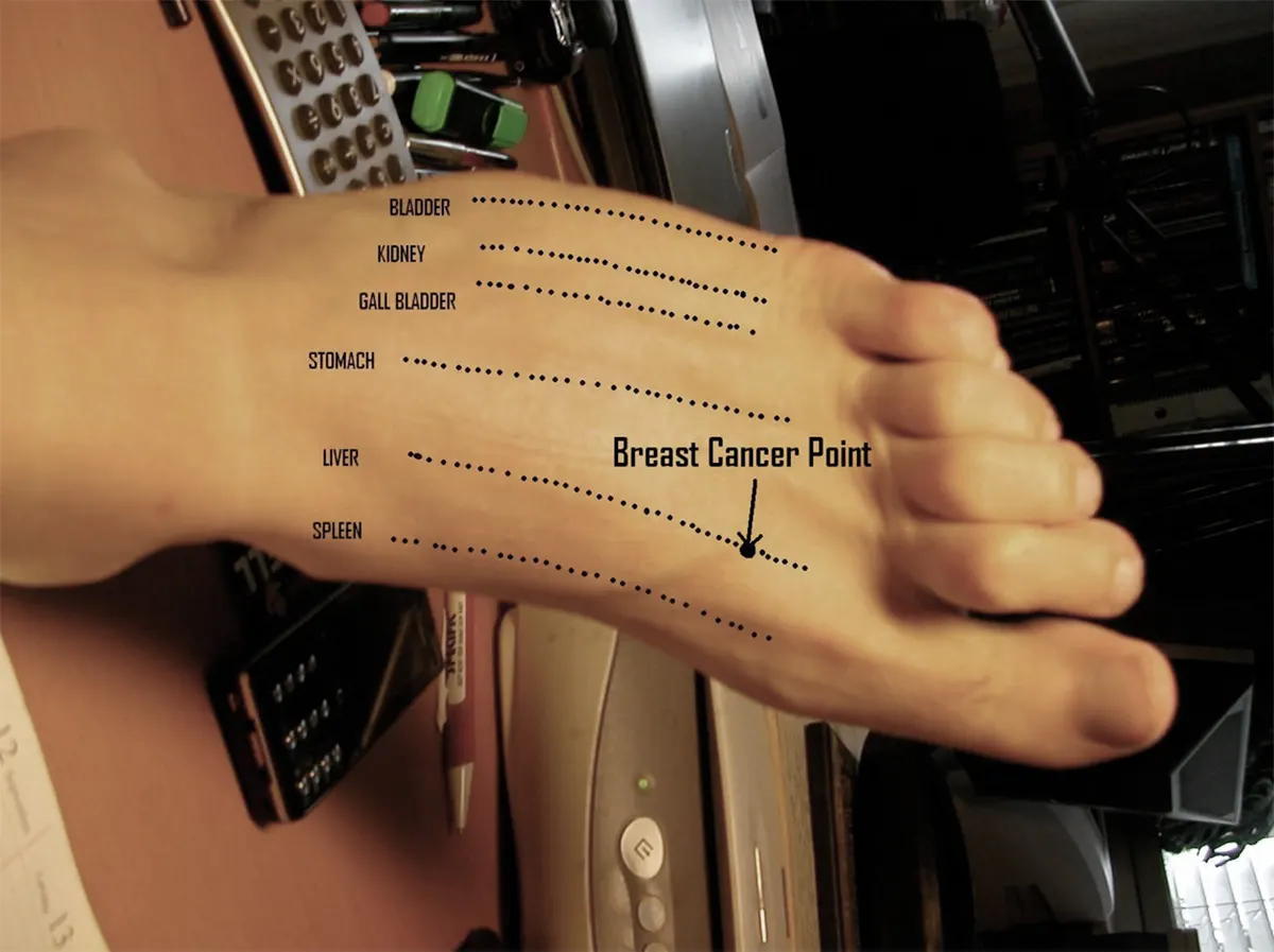 Picture 1; example of the point used for treating breast cancer.